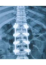 Tufts Medical Center’s Spine Center is one of the few places regionally to administer a numbing medicine during a minimally invasive spinal fusion. 
