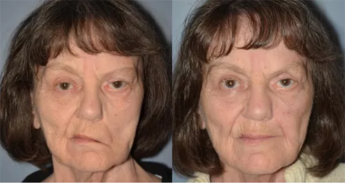 before and after facial surgery