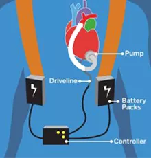 Graphic of a person wearing an LVAD